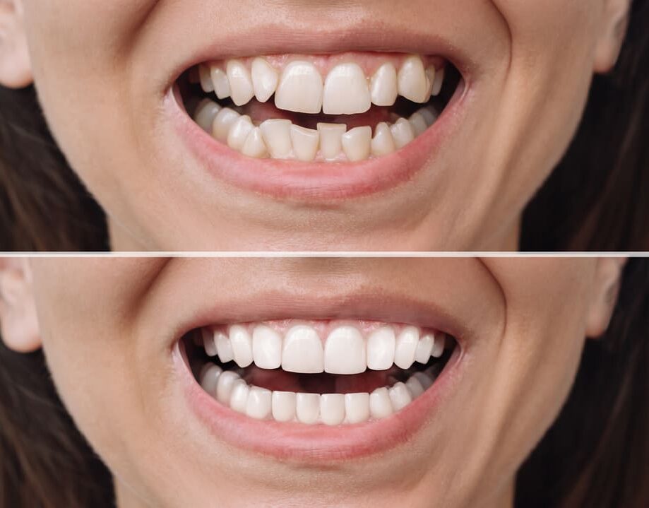 premiun-odonto_Invisalign_antes-e-depois (1)