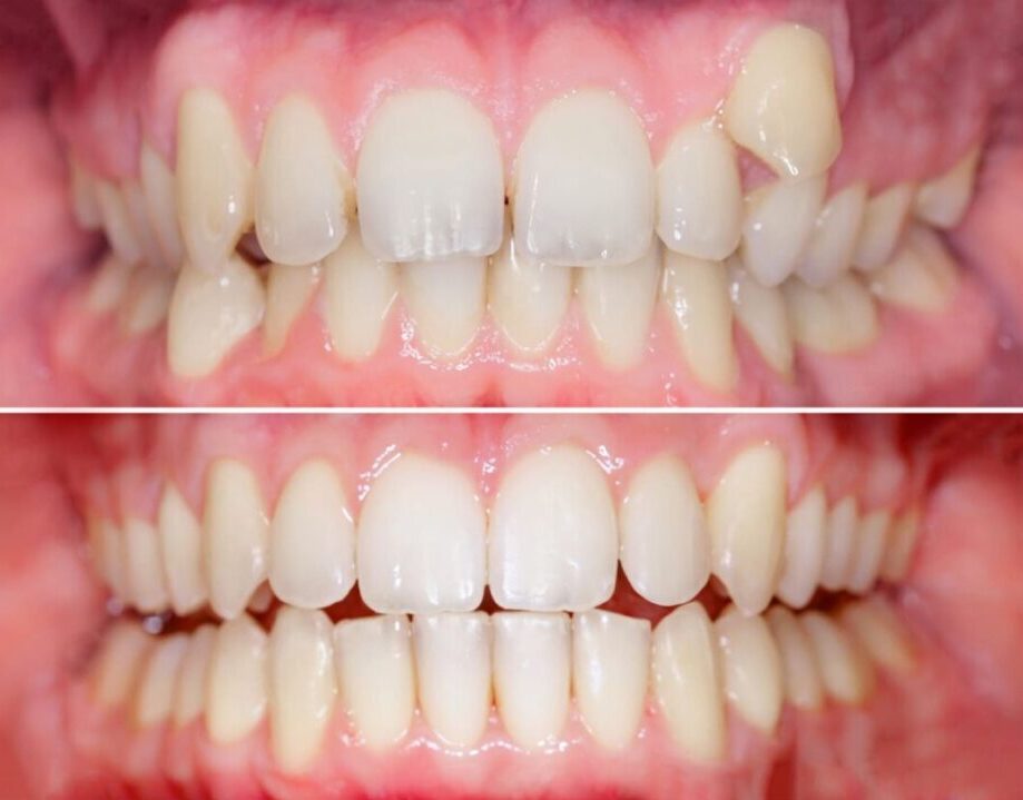 premiun-odonto_Invisalign_antes-e-depois (3)