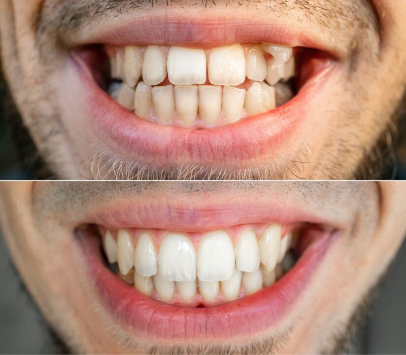 premiun-odonto_Invisalign_antes-e-depois (4)